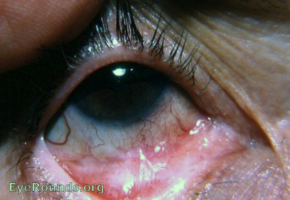 ocular pemphigoid