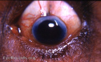 cataract: phthisis bulbi post cataract surgery