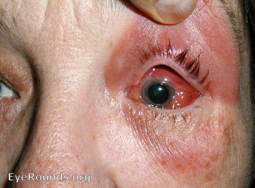 cellulitis under eye