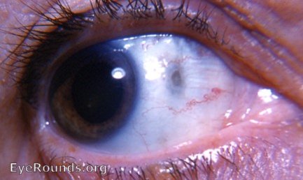 scleral hyaline plaque OD