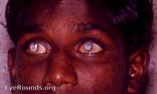 smallpox blindness - destroyed corneas-result of hypopyon ulcer ou
