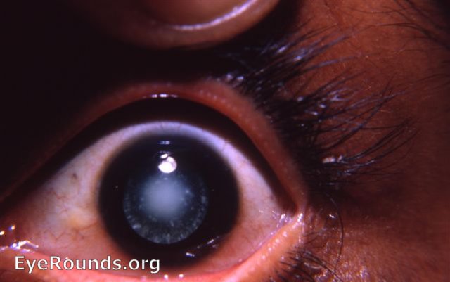 congenital cataract