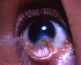 Symblepharon at site of perforating ulcer of cornea