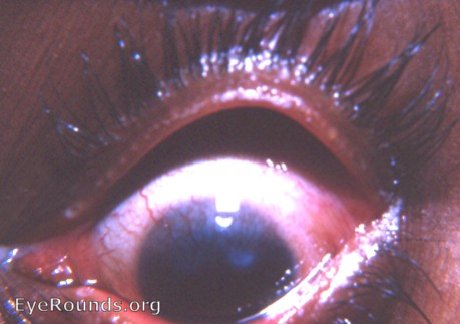 trachoma: a perfect photo of established trachoma with conjunctivitis, florid pannus, corneal scarring, and trichiasis