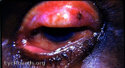 trachoma with extensive superior tarsal conjunctival scarring