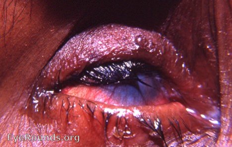 trachoma: advanced stage with trichiasis, corneal opacification with extensive neovascularization, humping of the superior tarsus.