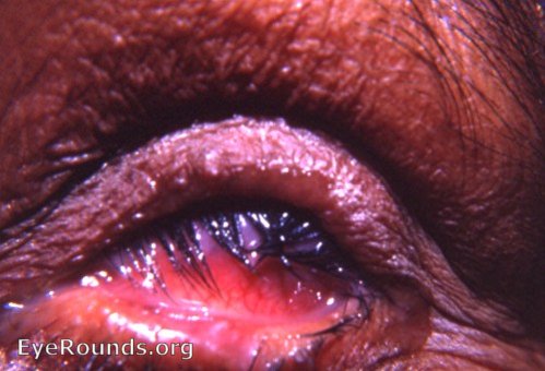 trachoma: trichiasis, outward convexity of the superior tarsus, and tylosis/ pachyblepharon.