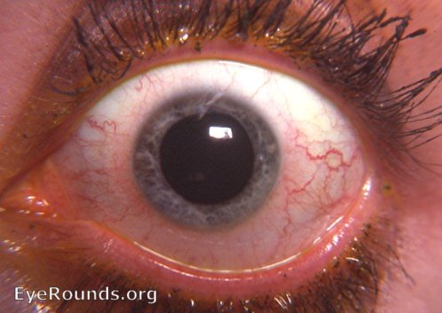 uveitis with iris atrophy and fixed, dilated pupil