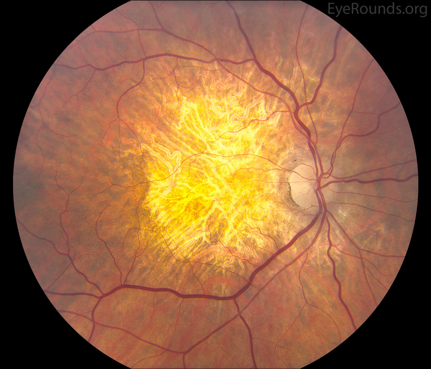 Non-exudative macular degeneration with extensive geographic atrophy