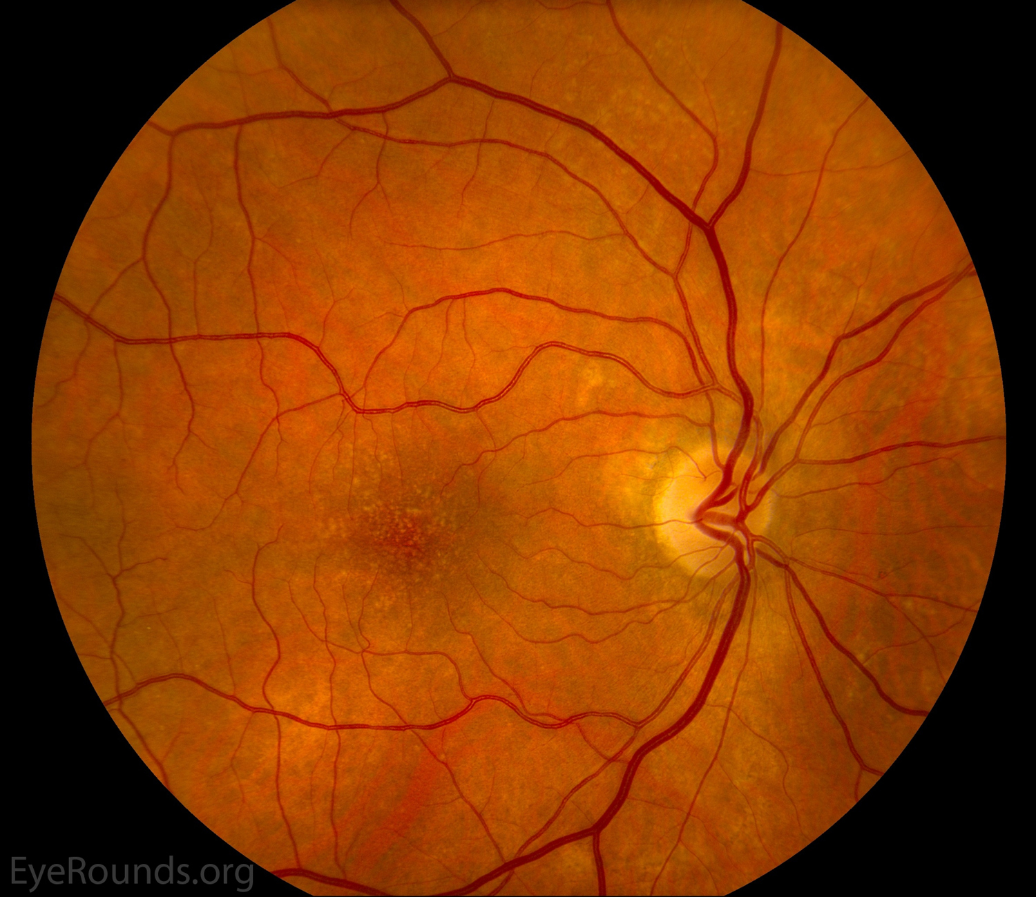 These fundus photos show early AMD 