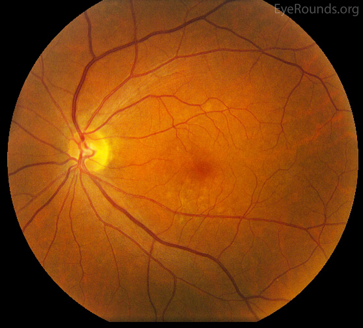 Shot for macular degeneration