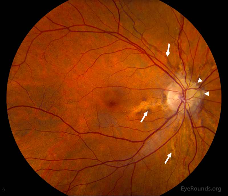Right eye (A): Disc drusen (arrow heads), normal vasculature, and angioid streaks (arrows) emanating from the optic nerve (click images for higher resolution).