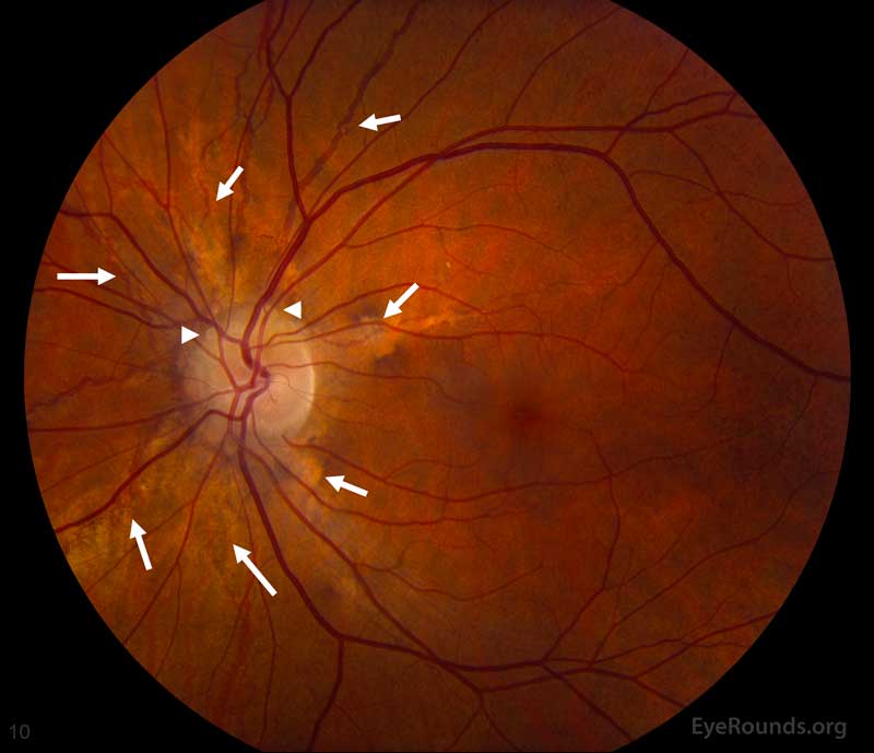 Left eye (B): Disc drusen (arrow heads), normal vasculature, and angioid streaks (arrows) emanating from the optic nerve
