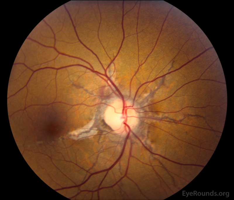 Right eye (A): Another example of angioid streaks emanating from the optic nerve