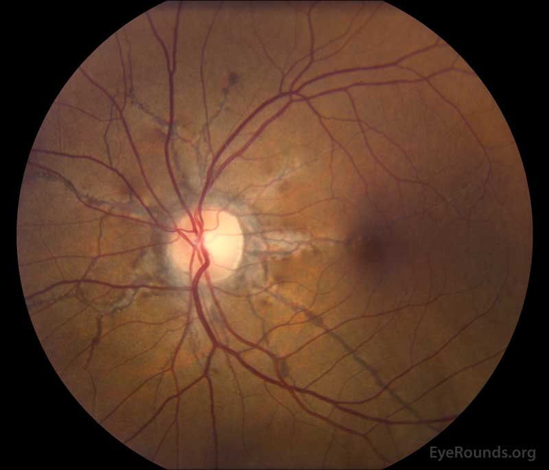 Left eye (B): Another example of angioid streaks emanating from the optic nerve