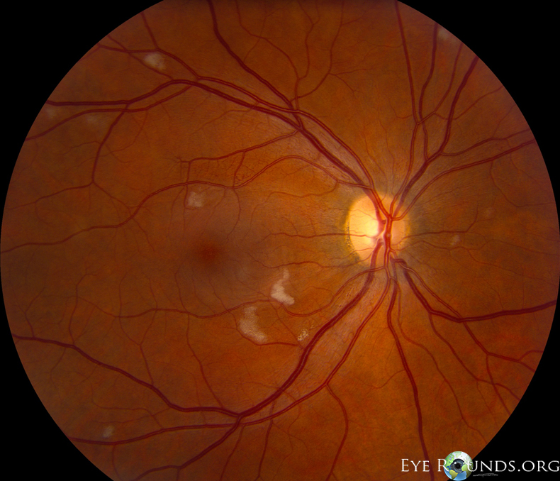 OD fundus with cotton wool spots