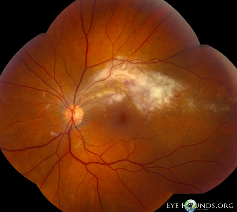 OS fundus with intraretinal hemorrhages along the superior arcades