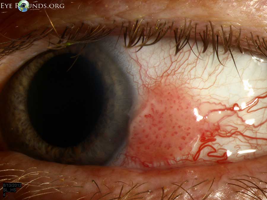 conjunctival intraepithelial neoplasia
