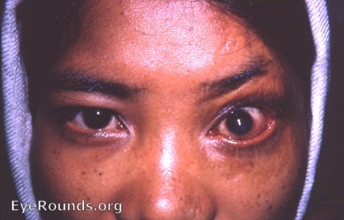 Cicatricial ectropin from burns sustained by Nepalese girl