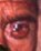 Marked ectropion with epidermalization of left lower lid