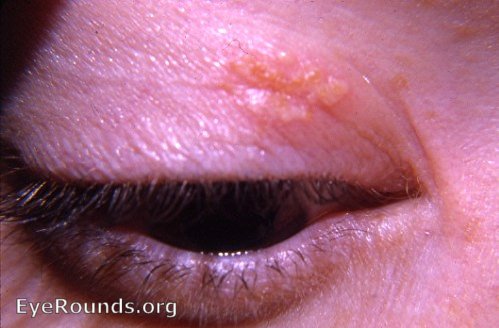 herpes simplex under eye