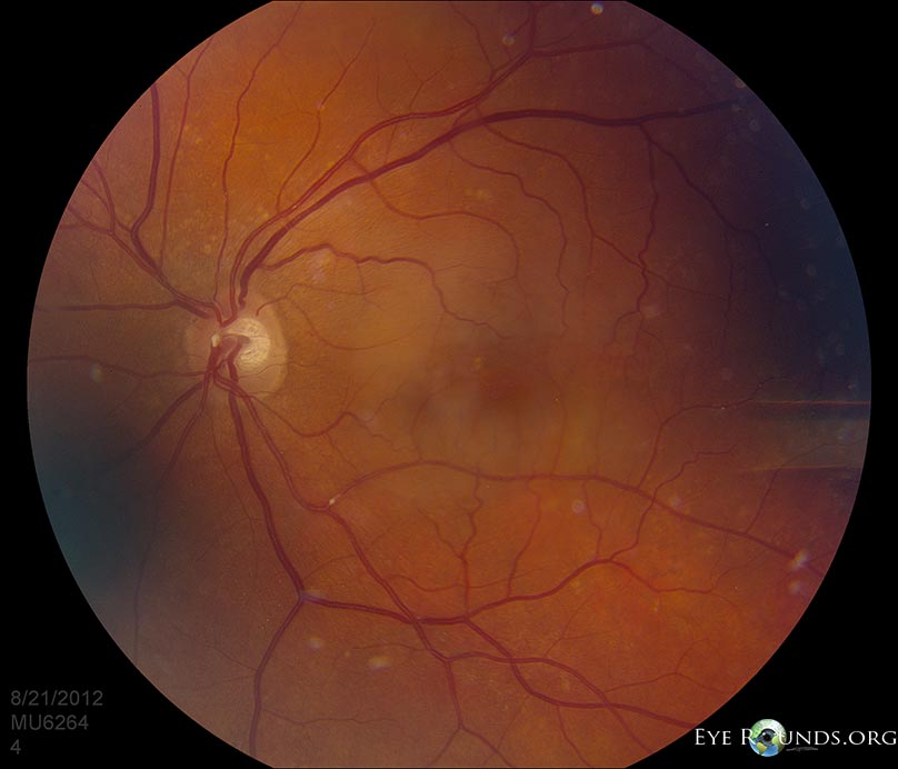 Atlas Entry Hollenhorst Plaque In Branch Retinal Artery Occlusion BRAO 
