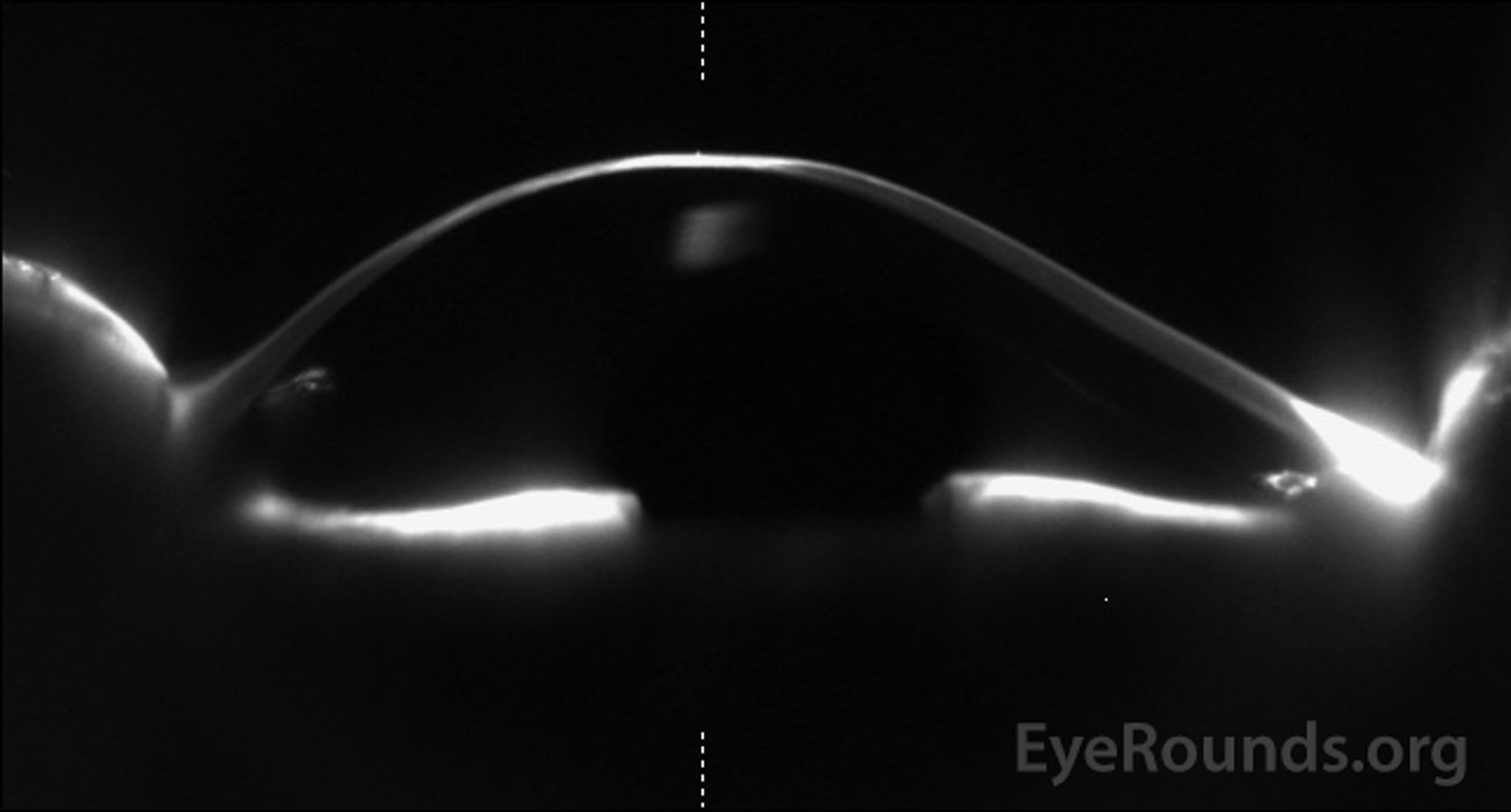 Scheimpflug imaging demonstrates the cone-shaped cornea of keratoconus 