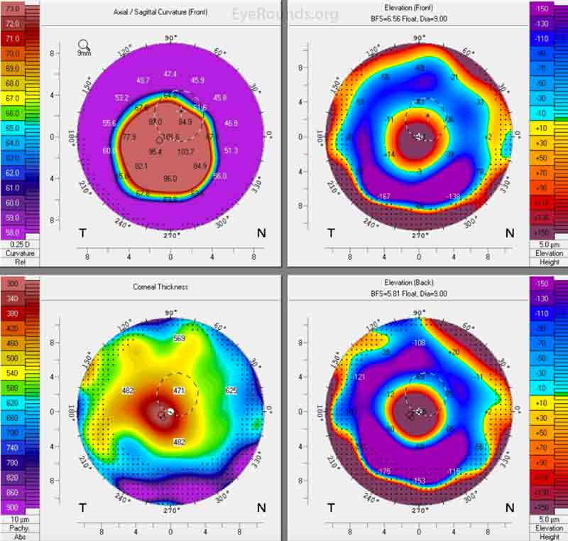 Keratoconus