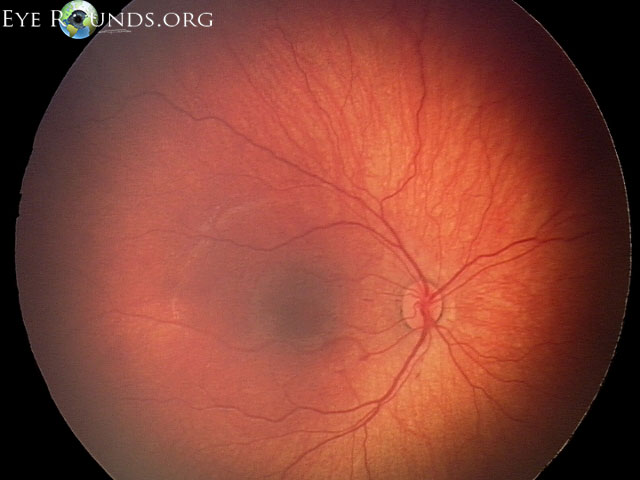 retinal hemorrhage shaken baby