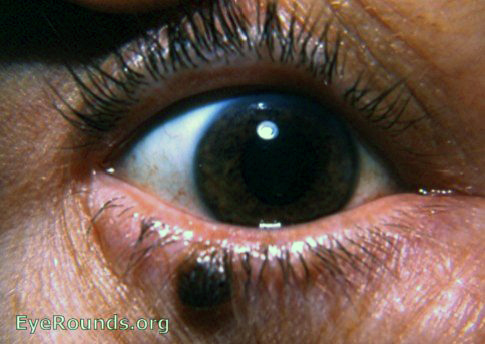 pigmented nevus of lower lid