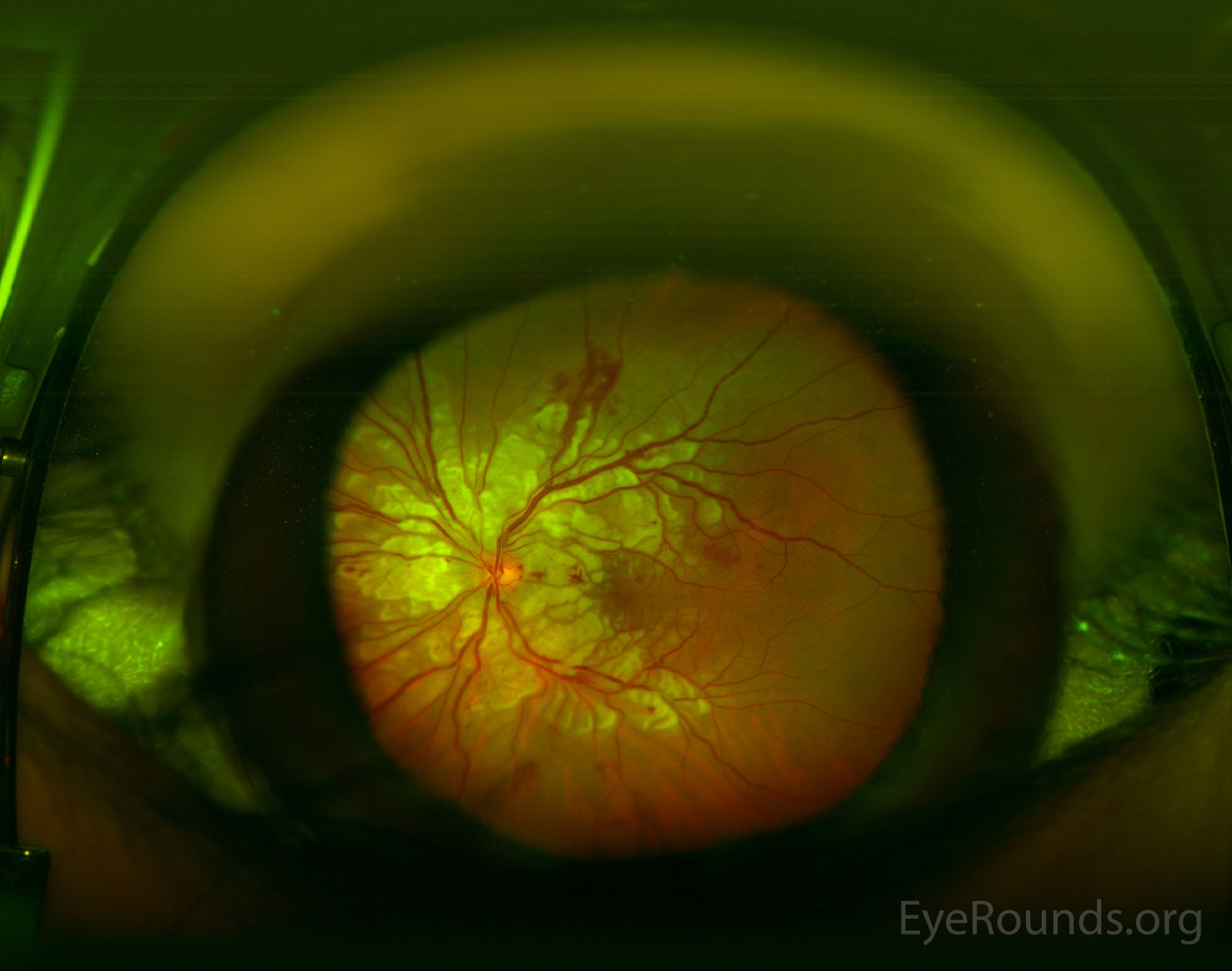 hipertónia retinopathia