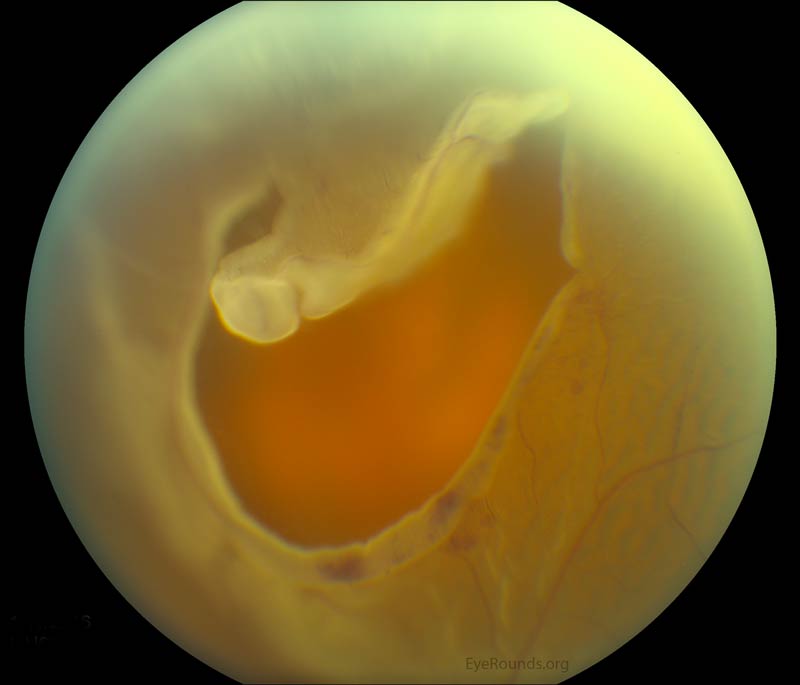 rhegmatogenous-retinal-detachment-the-university-of-iowa-ophthalmology