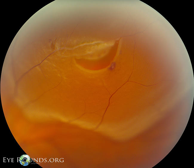 primary horseshoe tear with two smaller retinal tears nearby