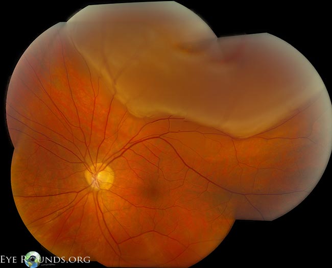 superior rhegmatogenous retinal detachment