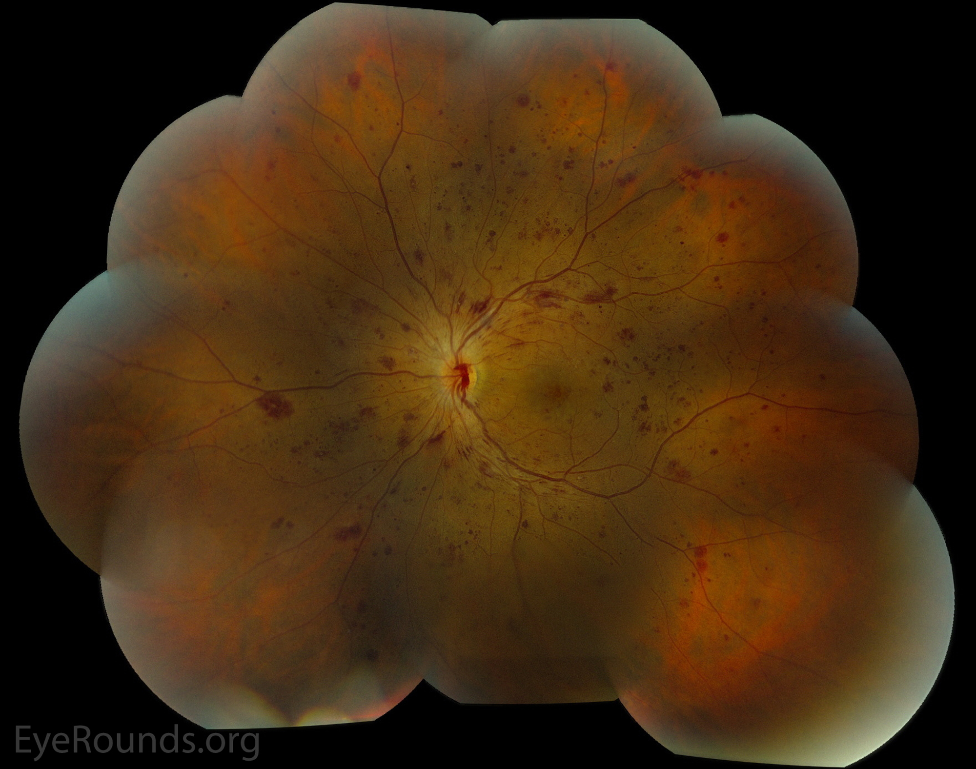 Radiation retinopathy