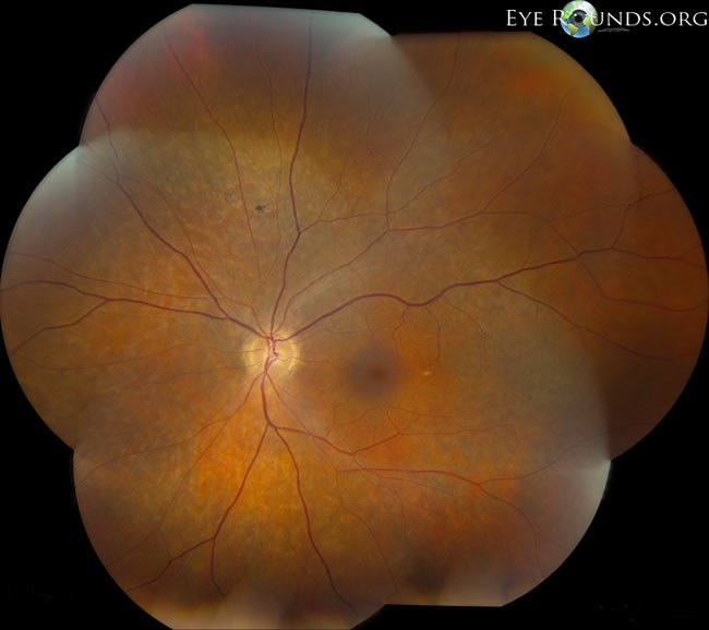 Retinitis pigmentosa sine pigmento