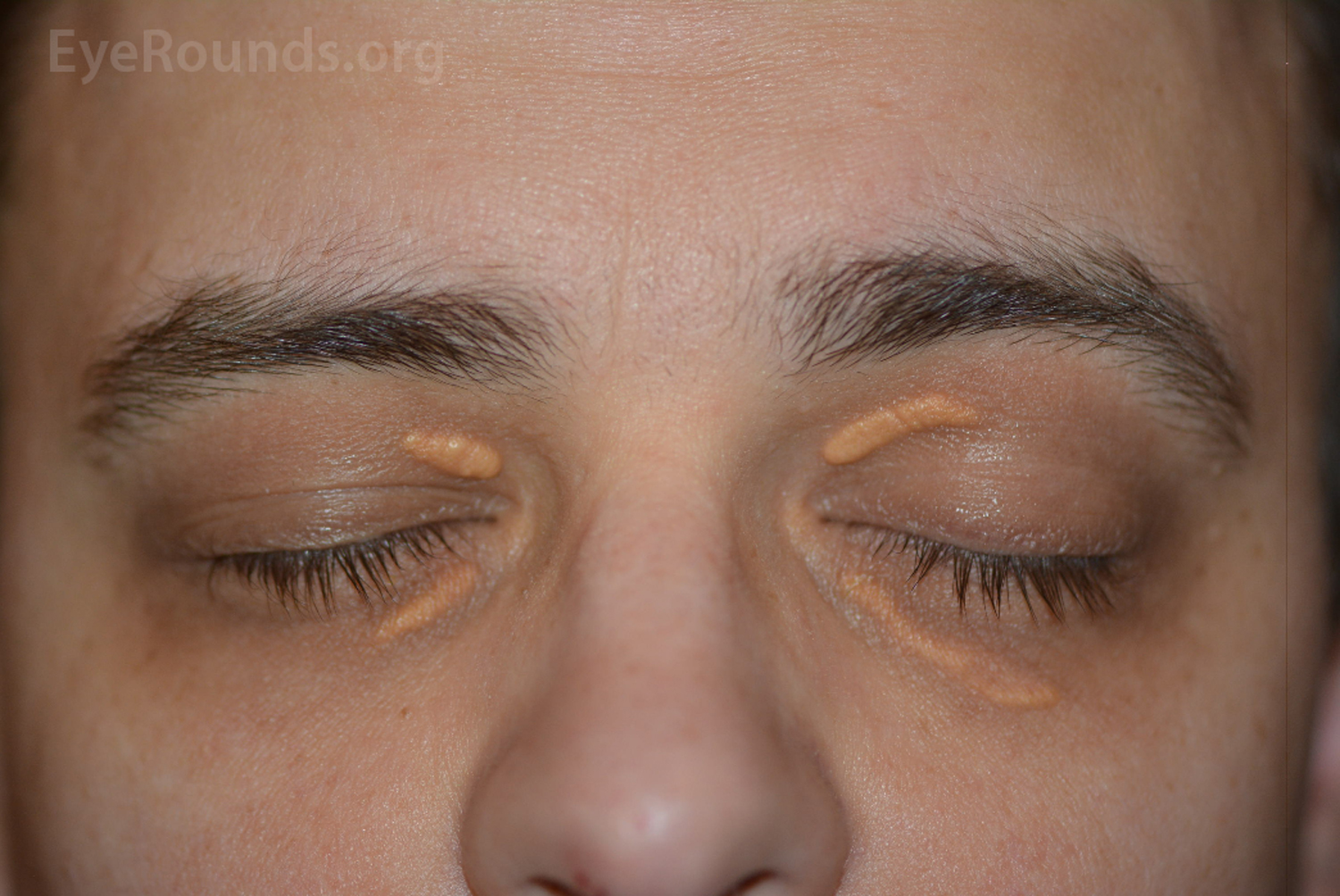 middle-aged man presented with bilateral symmetric yellowish lesions on the medial upper and lower eyelids