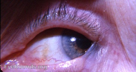 Ocular Disease - Midterm 1 Lids Part 1 - Quiz