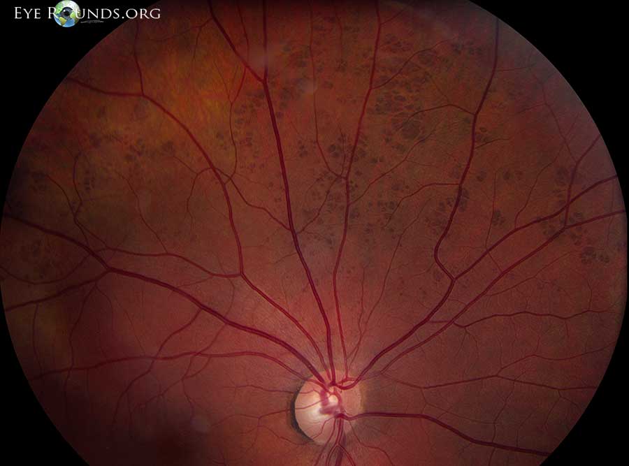 Atlas Entry Congenital Hypertrophy Of The Retinal Pigmented 