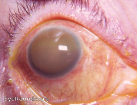 Classic blood stainig of the cornea following cataract surgery