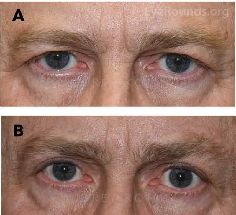 demonstrates a direct comparison of the patient's preoperative appearance (Figure 2A) and postoperative appearance 1 year after surgery (Figure 2B).  He has excellent cosmetic results and the scars are not noticeable.  