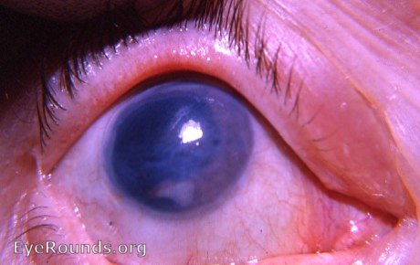 bullous keratopathy following intracapsular cataract surgery -