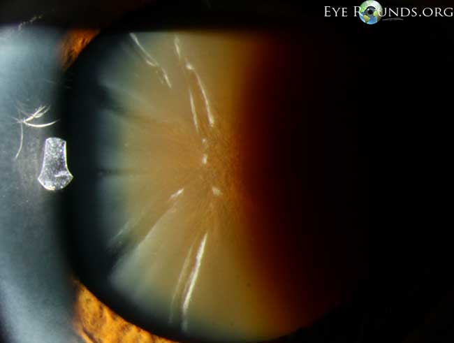 what type of cataract is this?