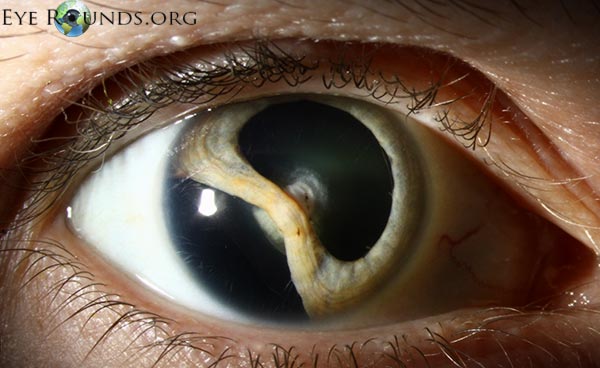 Erosive Vitreoretinopathy, right eye