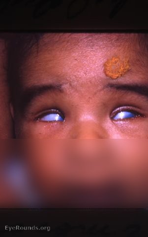 Blindness-mother had chickenpox during 1st trimester