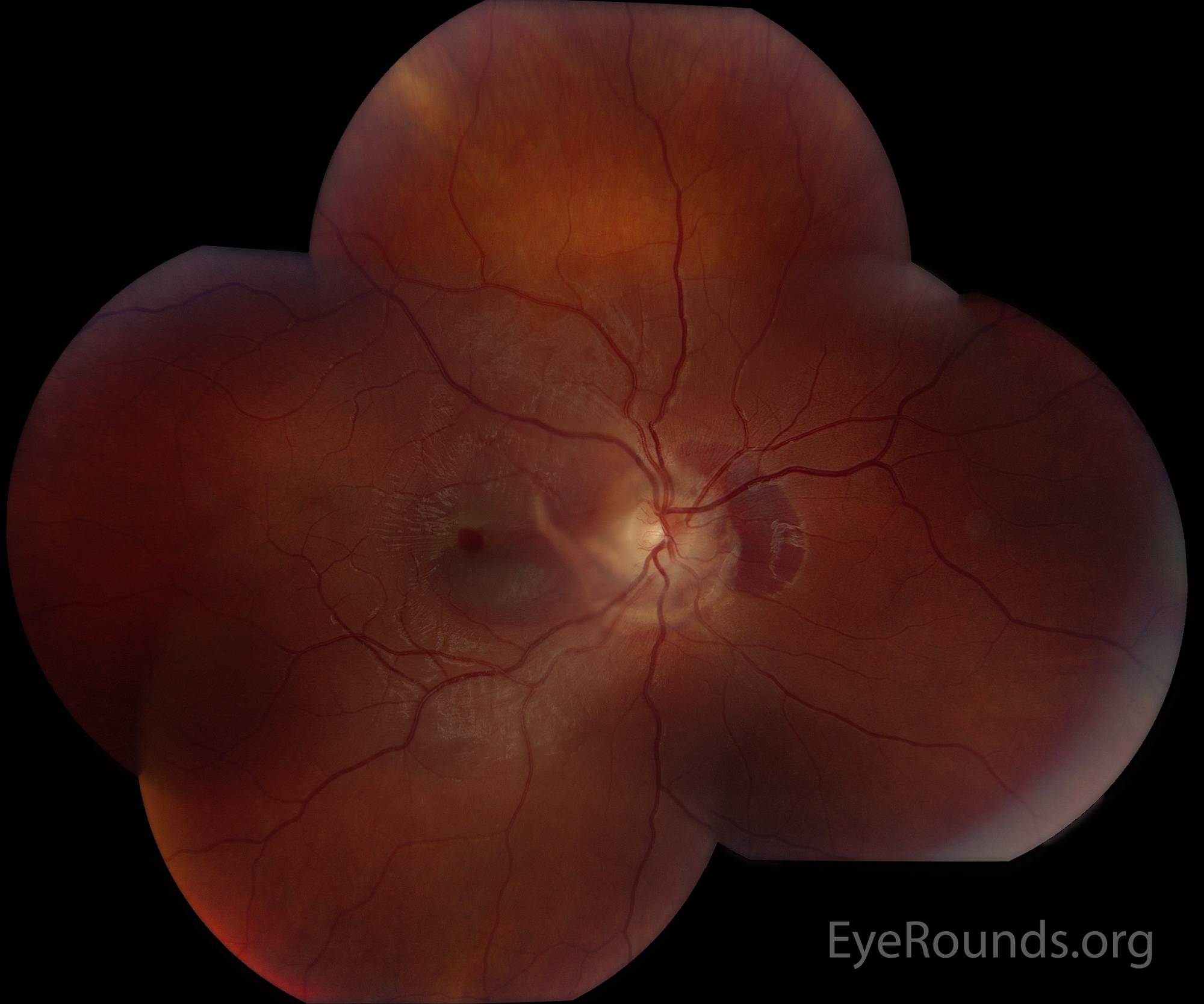  Color fundus montage photograph of the right eye shows a macular hole and peripapillary choroidal ruptures extending into the macula