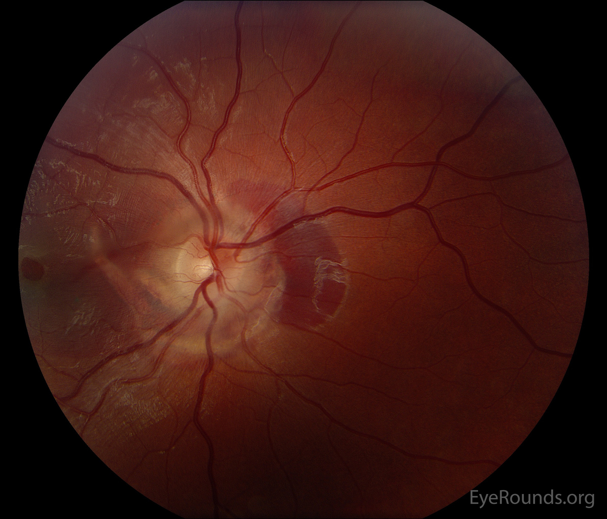  Color fundus photograph of the right eye shows a macular hole and peripapillary choroidal ruptures extending into the macula