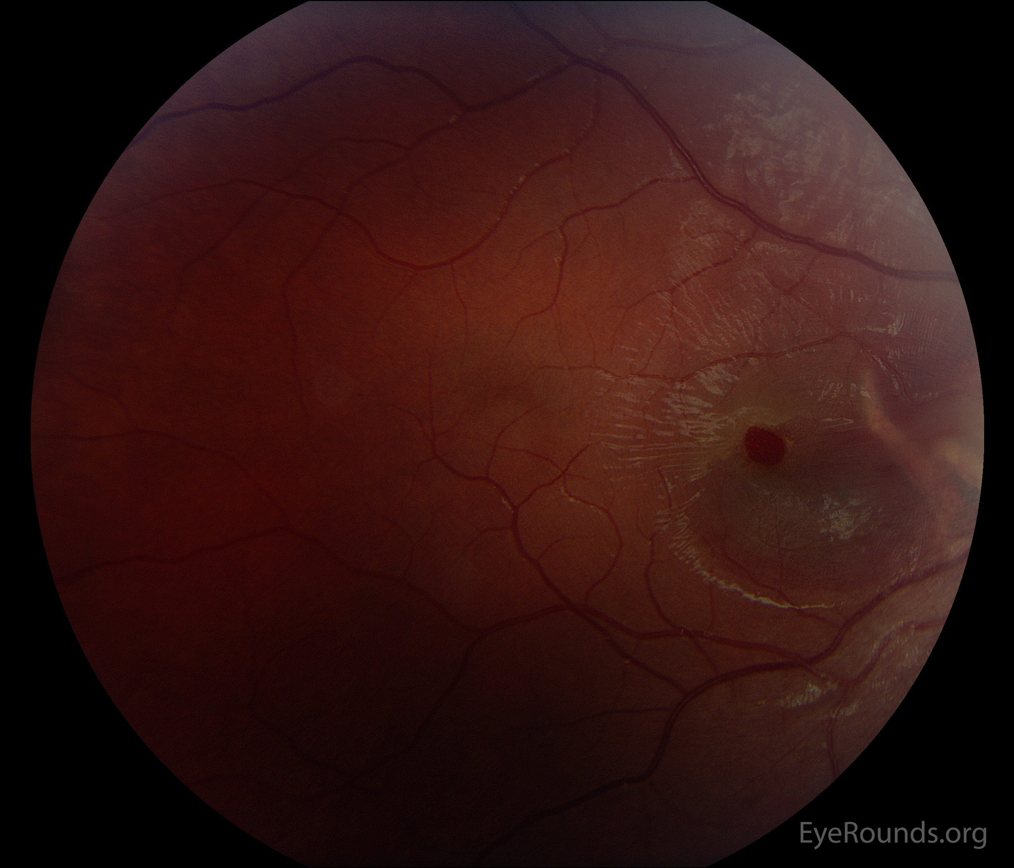  fundus showing macular hole