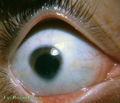 Microcornea with coloboma of iris and choroid
