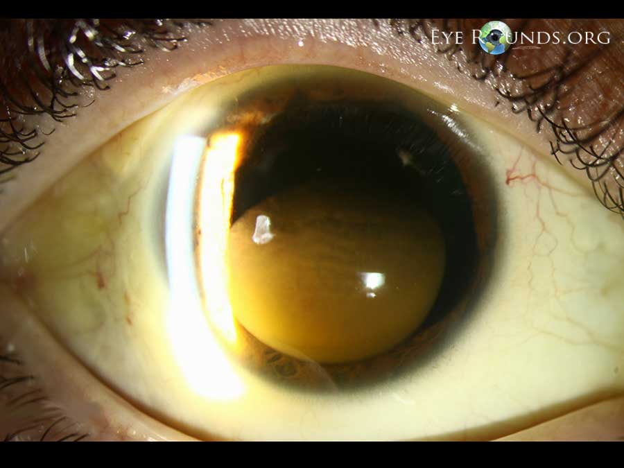 Corneal Blood Staining. EyeRounds.org Online Ophthalmic Atlas